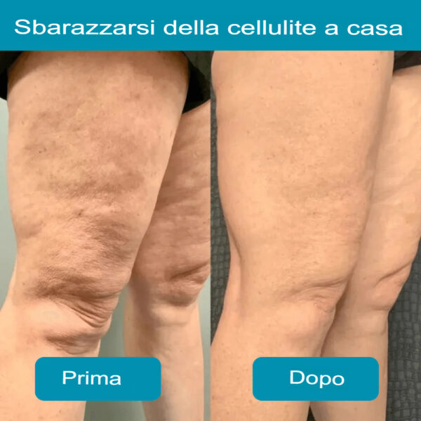 Cellulite Massager - immagine 5