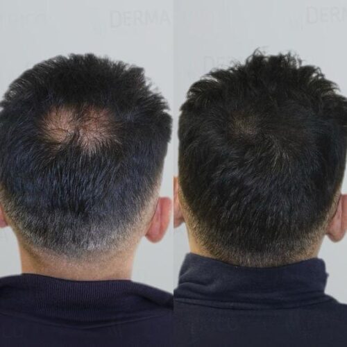 Firmelià® Sistema di Micro-Infusione per Ricrescita Capelli photo review