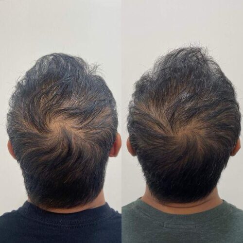 Firmelià® Sistema di Micro-Infusione per Ricrescita Capelli photo review