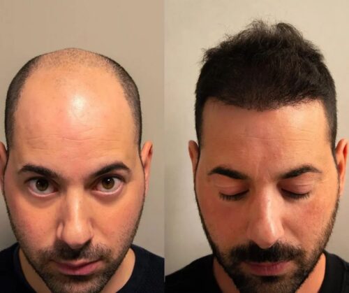 Firmelià® Sistema di Micro-Infusione per Ricrescita Capelli photo review